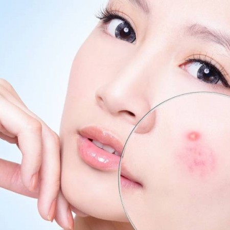 Mụn hình thành thế nào ?