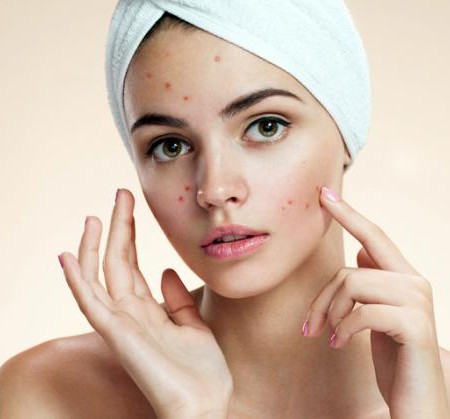 Mụn trứng cá – nguyên nhân từ đâu ?