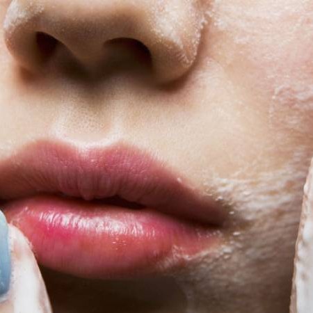 Rửa mặt quá nhiều gây mụn