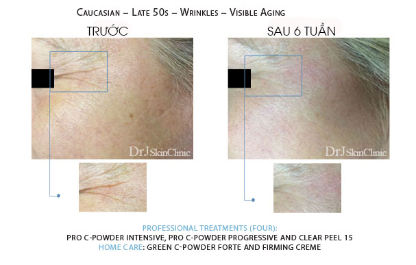 Huyết thanh vitamin C DrJ Skinclinic Green C-Powder Forte Kit 5 Huyết thanh vitamin C DrJ Skinclinic Green C-Powder Forte Kit 7