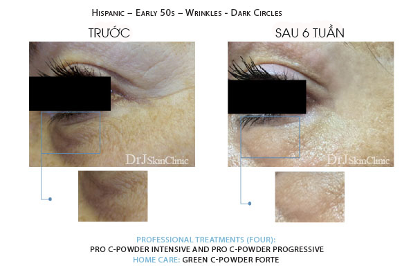 Huyết thanh vitamin C DrJ Skinclinic Green C-Powder Forte Kit 6 Huyết thanh vitamin C DrJ Skinclinic Green C-Powder Forte Kit 8