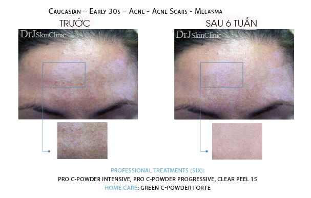 Huyết thanh vitamin C DrJ Skinclinic Green C-Powder Forte Kit 7 Huyết thanh vitamin C DrJ Skinclinic Green C-Powder Forte Kit 9