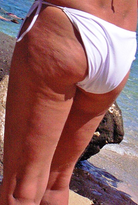 Cellulite da sần vỏ cam và cách khắc phục 129