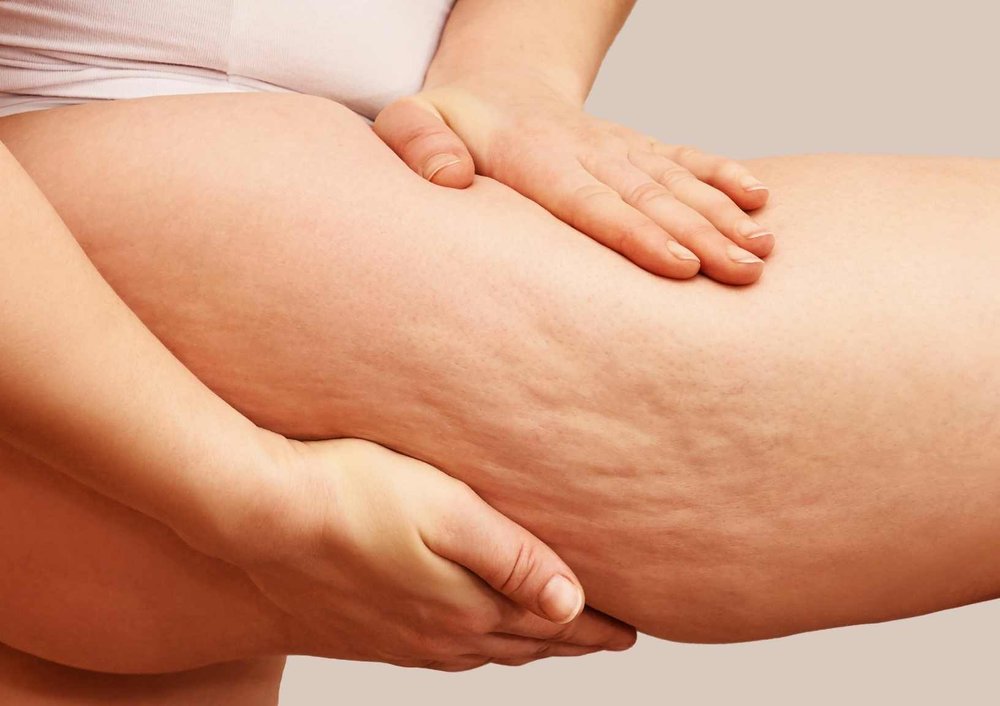 Cellulite da sần vỏ cam và cách khắc phục 128